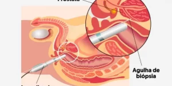 Biopia prostata Dr.mauro barros
