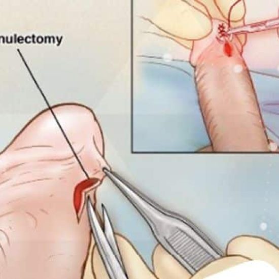 frenuloplastia-maceio